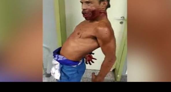 Hombre herido aterroriza en hospital; actúa como zombi