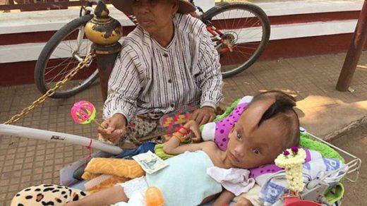 El extraño caso del niño de Camboya que vive con su cabeza partida en dos