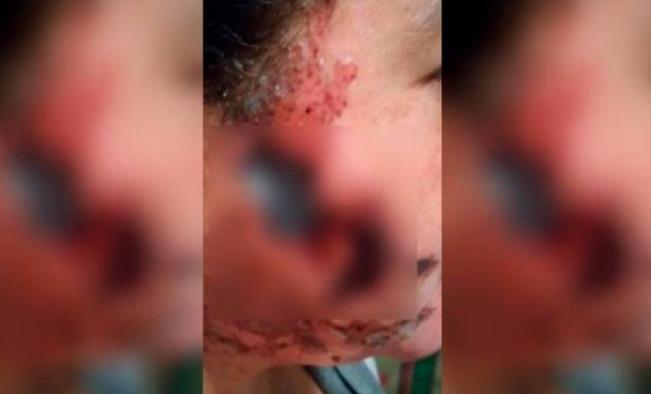 Maestro arroja ácido al rostro de su pareja en Tepeaca, Puebla