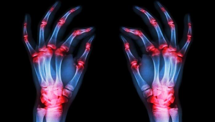 Qué probar y qué ni siquiera tratar para la artritis