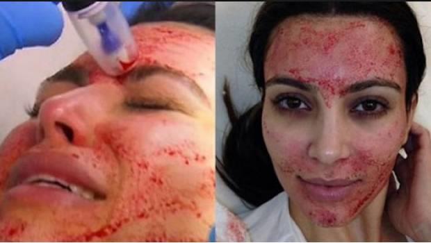 Facial de vampiro contagió de VIH a clientes de un spa