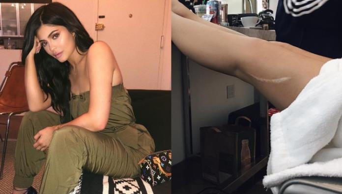 OMG! La terrible historia de la cicatriz de Kylie Jenner