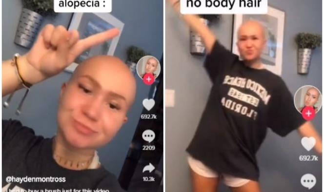 Joven muestra con humor las ventajas de tener alopecia