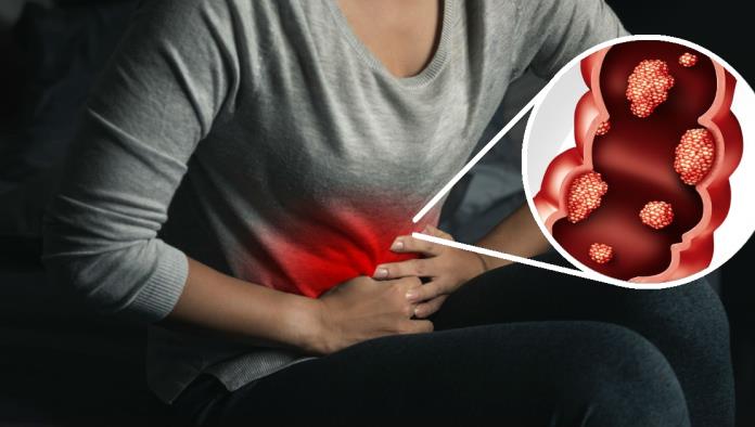 Factores que elevan el riesgo de padecer cáncer de colon en mujeres