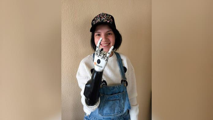 Una mujer rusa a quien su marido le cortó ambas manos con un hacha recibe una prótesis biónica