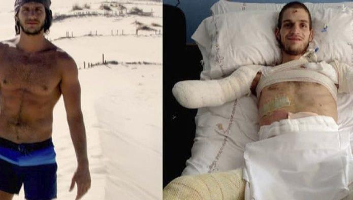 Volver de la muerte: Le cortan brazos y piernas por una bacteria