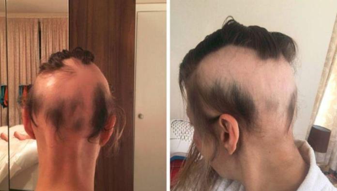 Se estresó para organizar su boda, dos semanas después perdió el 90% de su cabello
