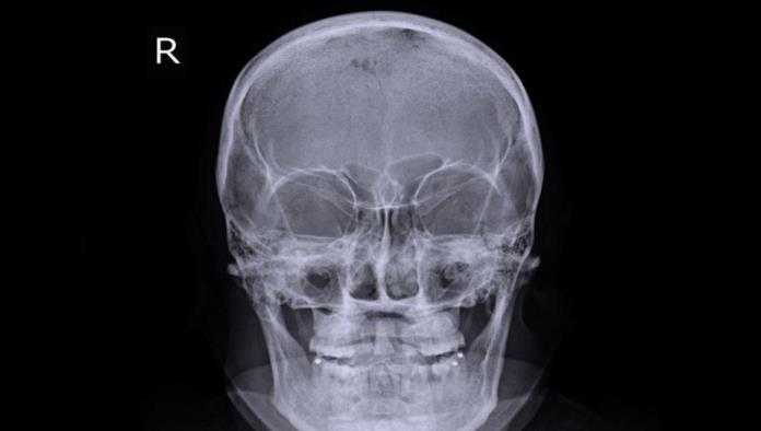 Hombre descubre que tuvo diente atorado en la nariz durante 20 años