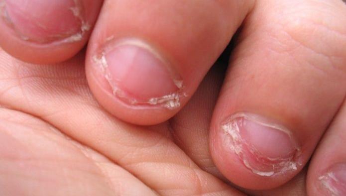 Mujer pierde su dedo pulgar por morderse las uñas