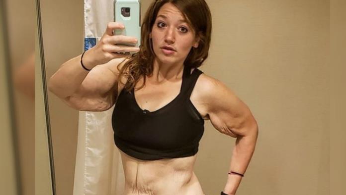 Tras adelgazar 140 kilos, mujer elimina de su cuerpo 3 kilos de piel