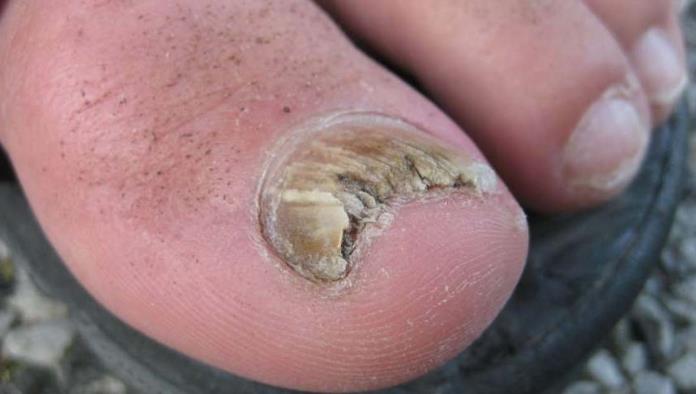Alerta Castaños por micosis en las uñas