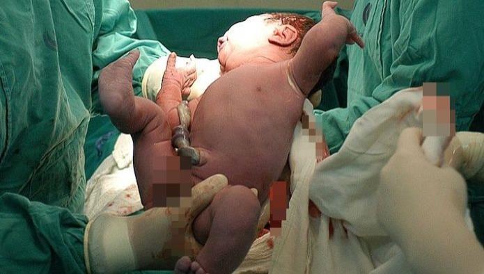 VIDEO: Una cesárea asombrosa, la bebé nace por cuenta propia