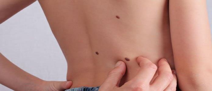 IMSS recomienda revisar manchas y lunares en la piel