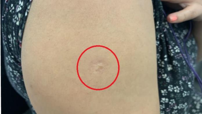 ¿Por qué los mexicanos tenemos esta cicatriz en el brazo?