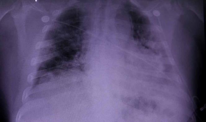 Daño pulmonar por covid-19 puede durar varios meses