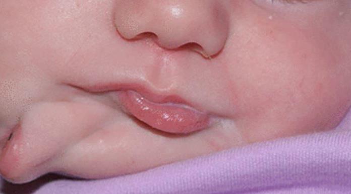 Nace una bebé con dos bocas; médicos logran curarla
