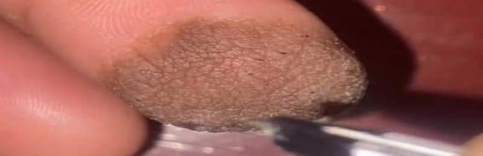 Mujer tiene vello púbico en el dedo tras injerto de piel