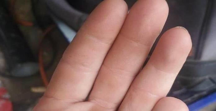 Encontró su dedo después de 6 meses, se había cortado con una sierra