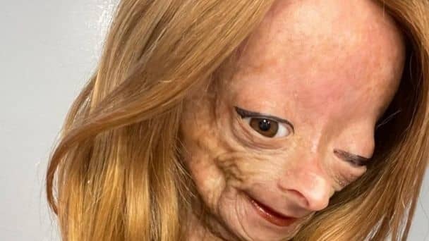 YouTuber con rara enfermedad de envejecimiento de Benjamin Button muere a los 15 años