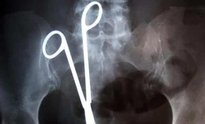 Mujer de 55 años vivió 20 años con unas tijeras en su estómago