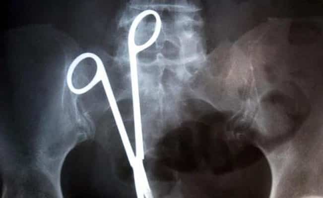 Mujer de 55 años vivió 20 años con unas tijeras en su estómago