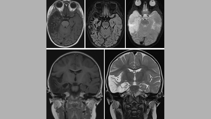 ¿Qué es la encefalitis?