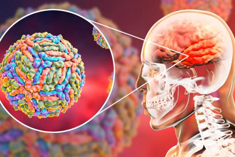 ¿Qué es la encefalitis?