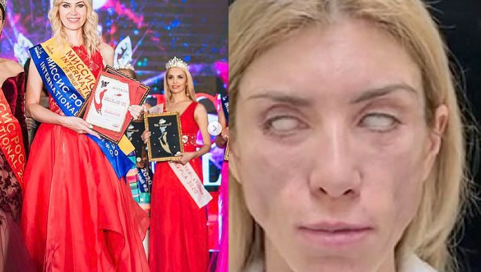 Reina de belleza no puede cerrar los ojos ni sonreír por cirugía plástica