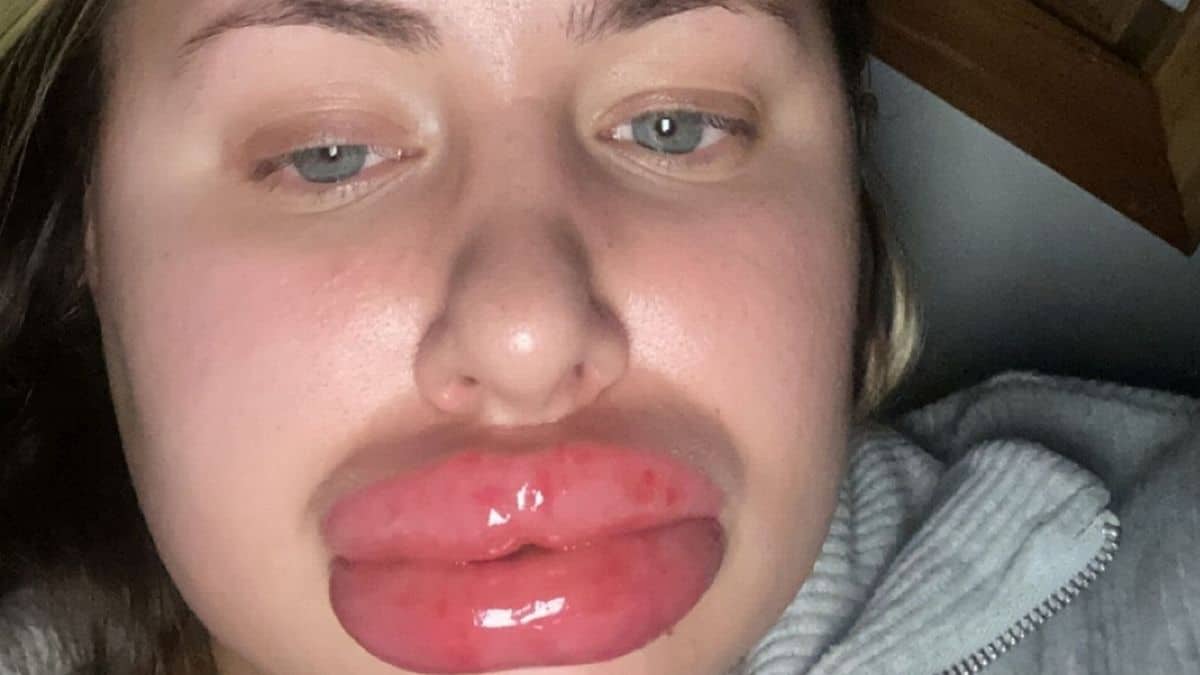 Mujer quedó con labios extra grandes al sufrir alergia al acido hialuronico