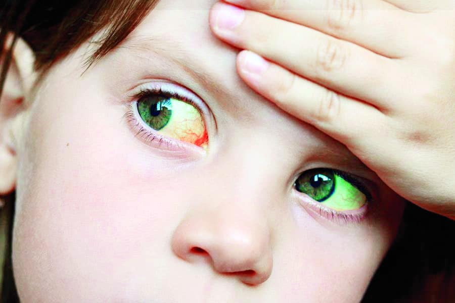 Especialistas médicos llaman a reforzar la higiene y a vigilar síntomas en niños como cambio de color en piel y ojos.