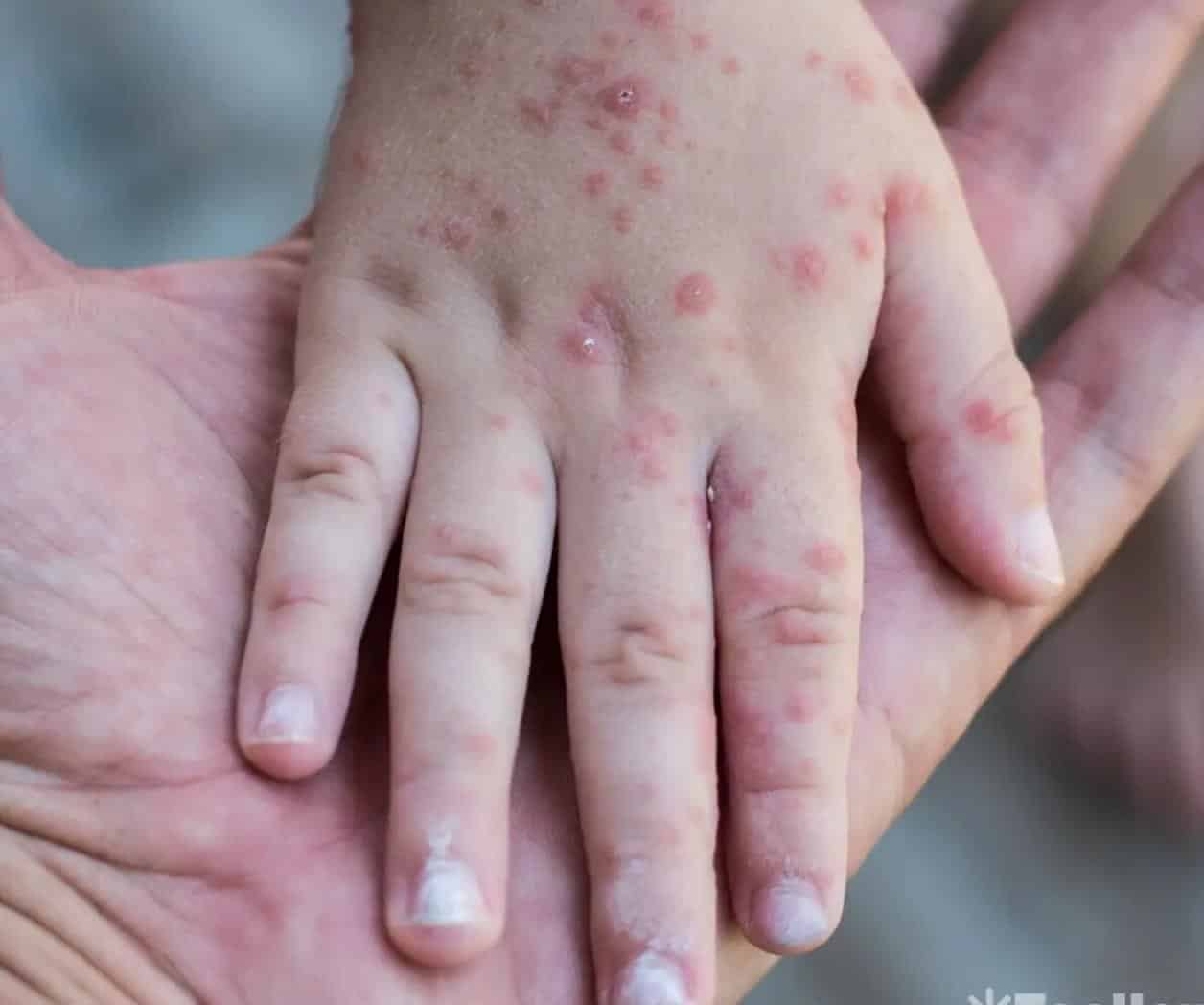Canadá detecta 77 casos de Viruela de Mono en Quebec