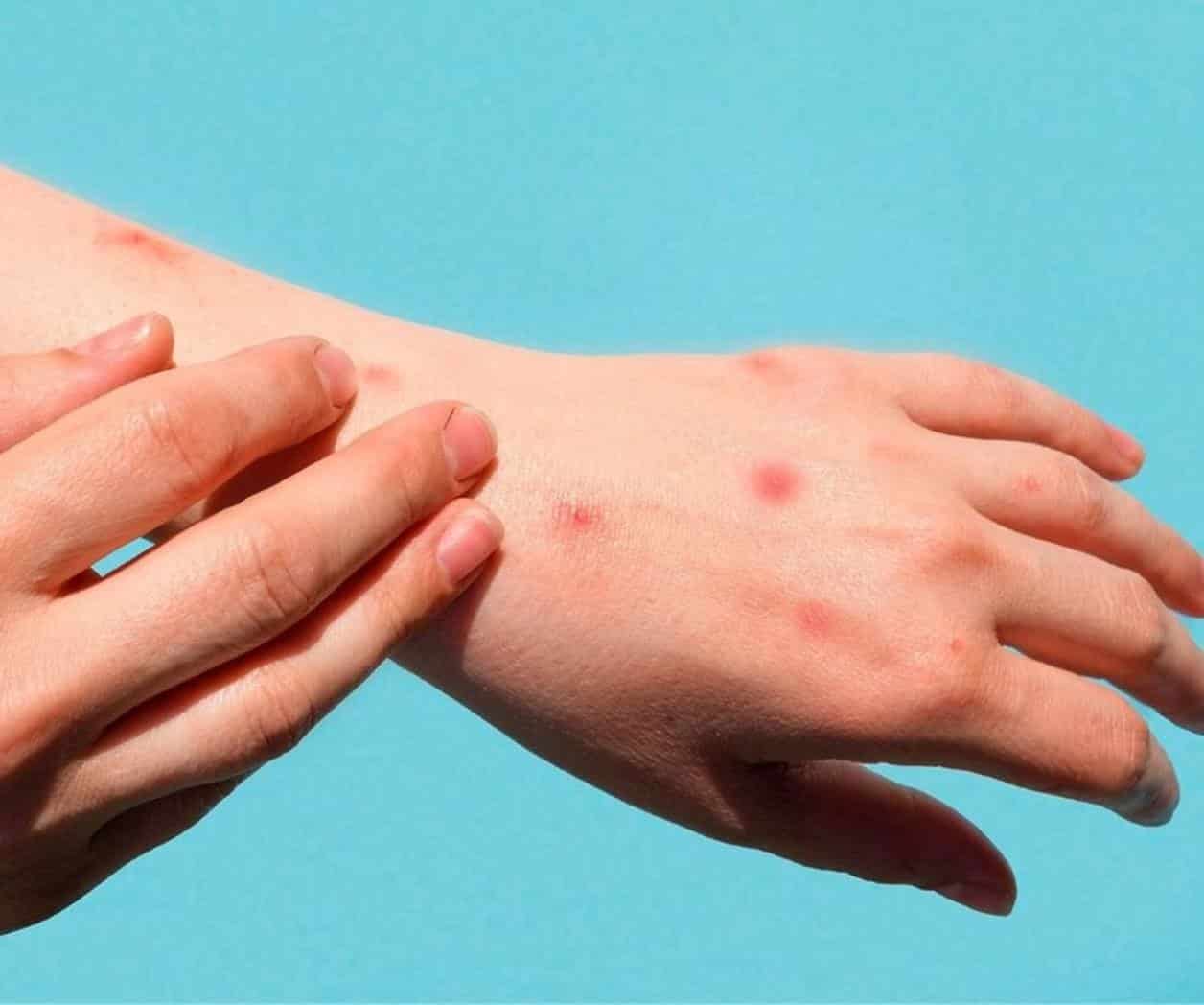 Alertan sobre la viruela del mono
