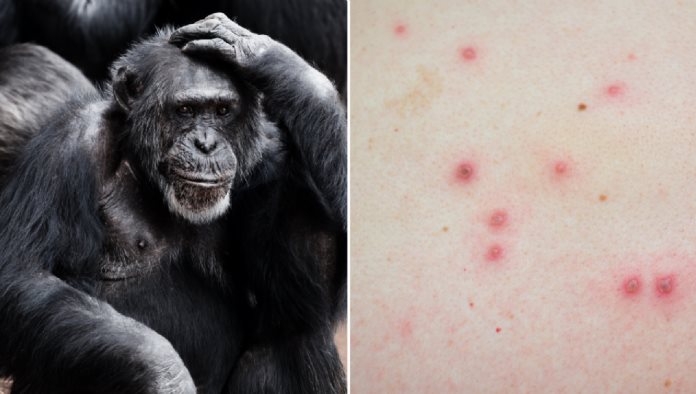 Viruela del mono no tarda en ser pandemia: Experto en OMS