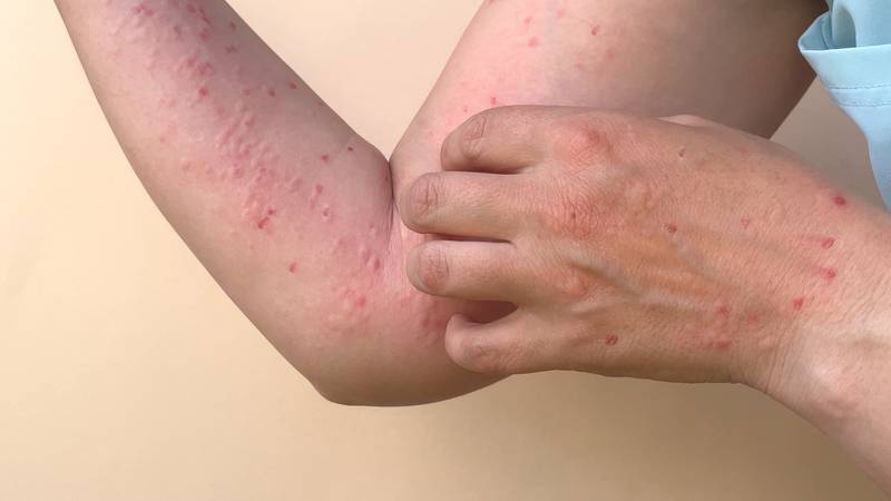 En México se han detectado 35 casos de contagios de la viruela del mono.
