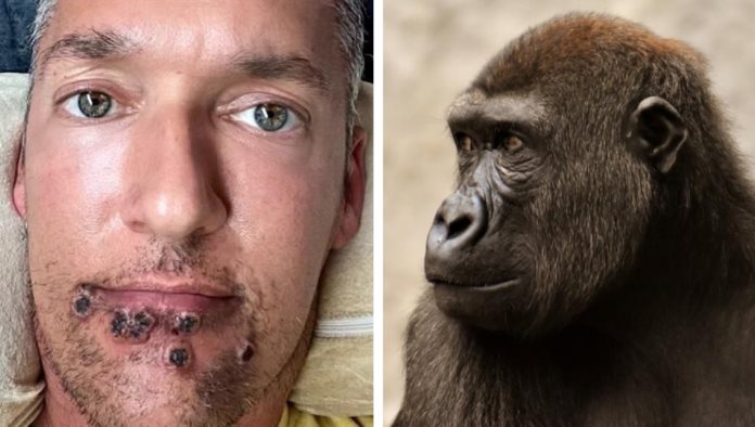 Actor porno relata su experiencia con la viruela de mono