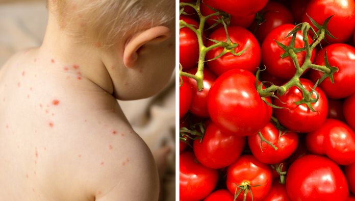 Gripe del tomate: Conoce la enfermedad que ha infectado a decenas de niños