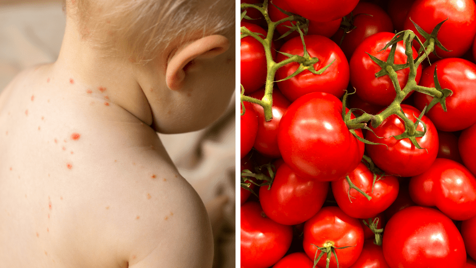 Gripe del tomate: Conoce la enfermedad que ha infectado a decenas de niños