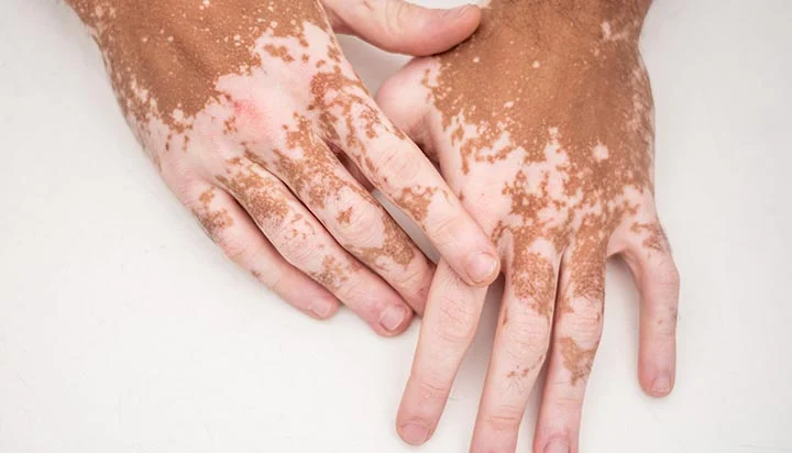 Europa aprueba uso de crema como tratamiento contra el vitiligo