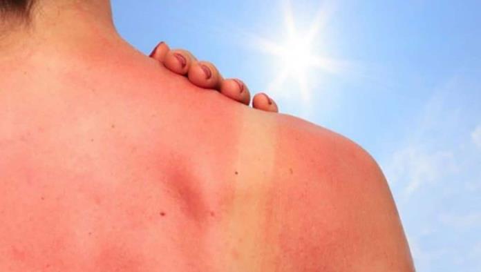 Llaman a prevenir Cáncer en la piel 