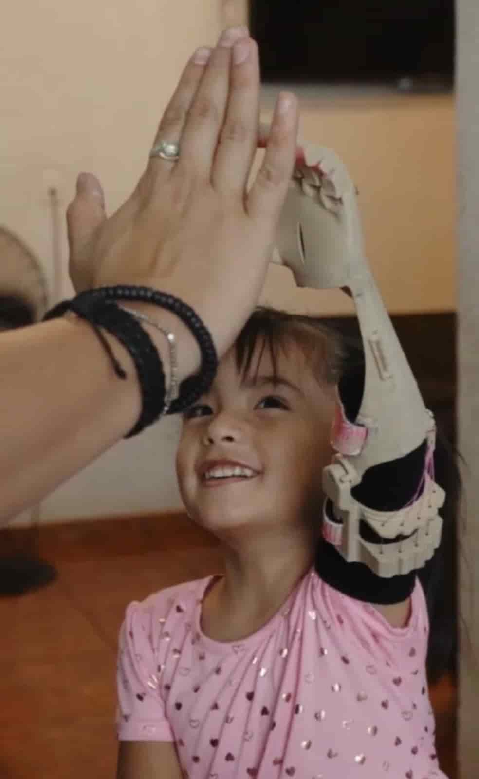 Recibe prótesis de antebrazo