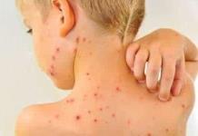 Reportan brote de varicela en jardin de niños