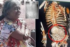 Abuelita brasileña va al doctor y le descubren feto ´momificado´; la operan y muere