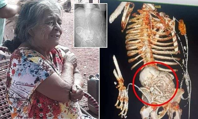 Abuelita brasileña va al doctor y le descubren feto ´momificado´; la operan y muere