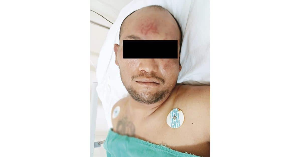 Exzael 34 Ingresa hombre lesionado al Hospital Chavarría.