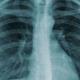 Detectan 3 casos de Tuberculosis en PN