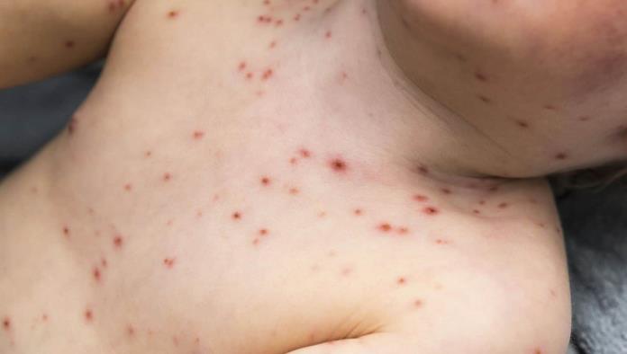 Aumentan casos de varicela en PN