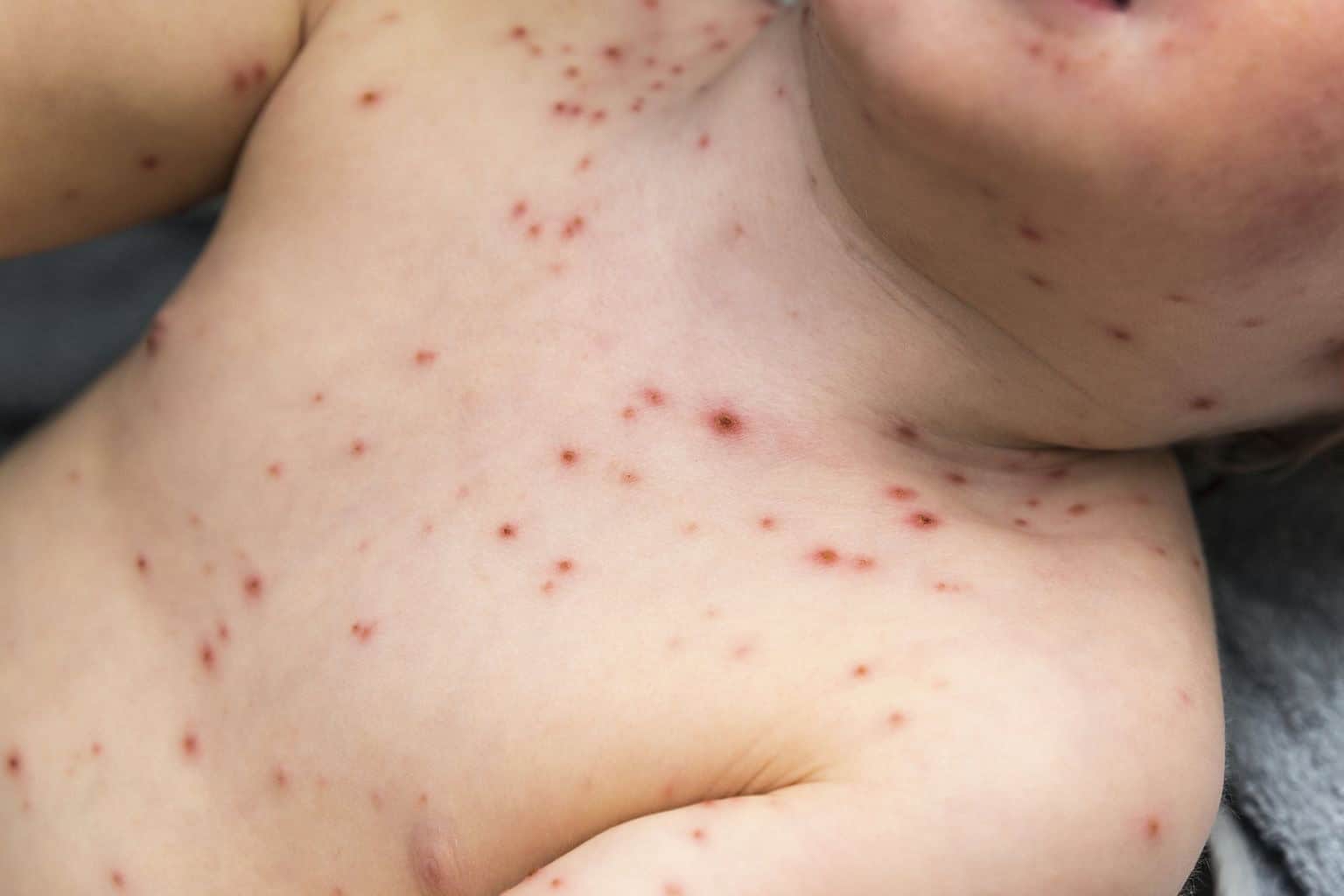 Aumentan casos de varicela en PN