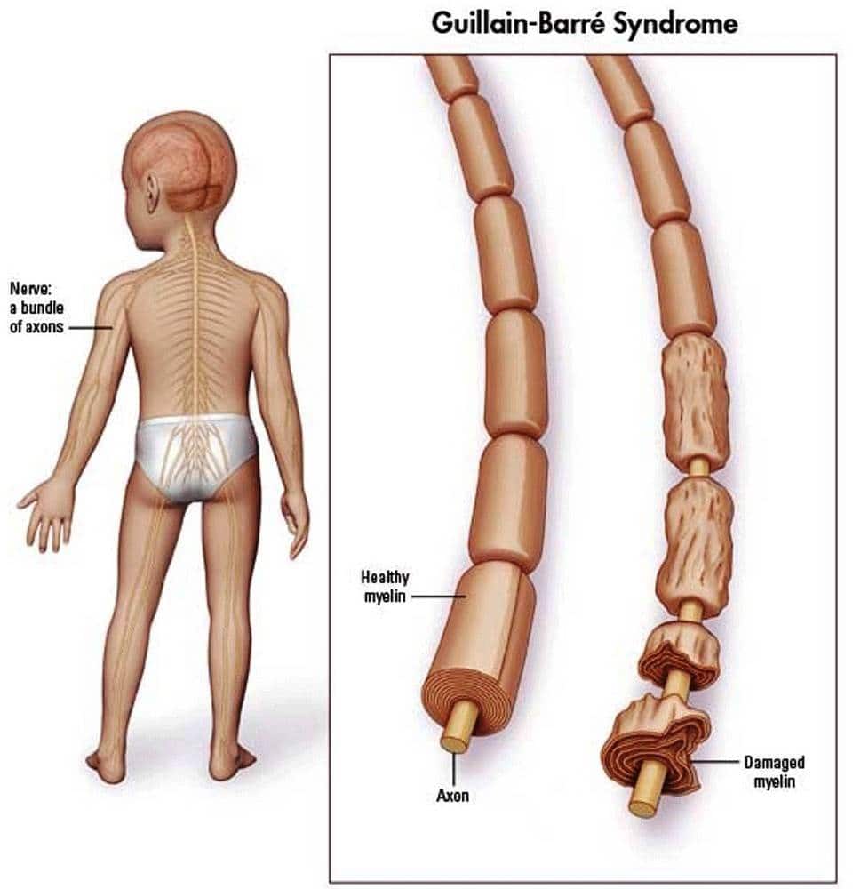 Se atienden casos de Sindrome Guillain Barre en menores de edad.