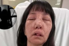 Casi desfigurada queda mujer tras ser atacada por arañas mientras limpiaba su casa en EU