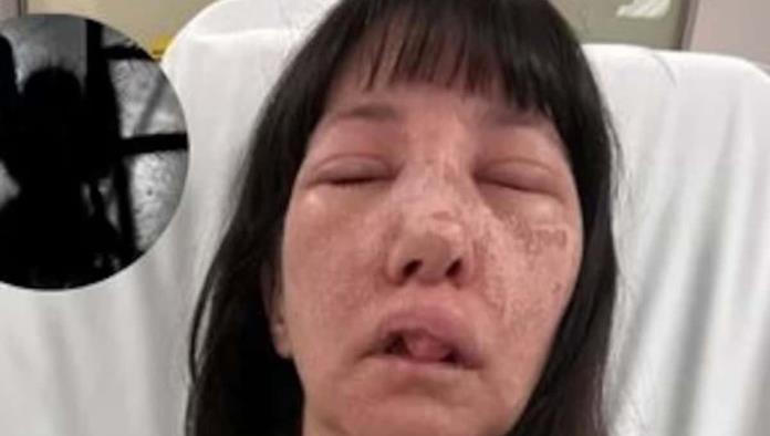 Casi desfigurada queda mujer tras ser atacada por arañas mientras limpiaba su casa en EU